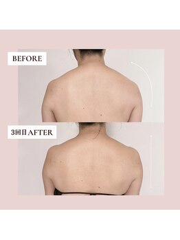 ミーティス/猫背改善&肩こり改善