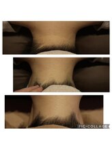 ベビースキン(baby skin)/えり足脱毛