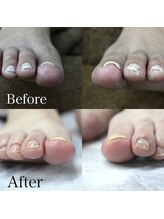 オーガニックネイルサロン プティ ボア(petit bois)/【巻き爪矯正】2回目