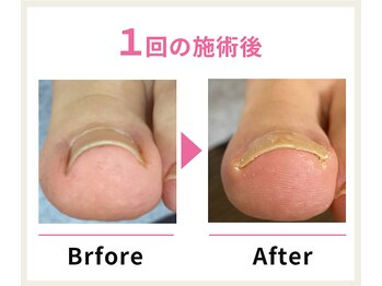 名古屋駅前巻き爪センターの写真/施術実績1万件以上!!《最新巻き爪補正「スマートリフト法」導入!!》技術力×信頼のあるサロン