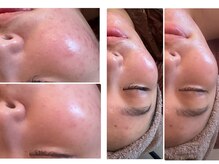 ★韓国肌管理ララピール★フェイシャルWax★毛穴洗浄で艶肌へ