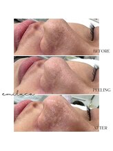 エミルカ(EMILUCA)/毛穴洗浄★ハイドロスプラッシュ