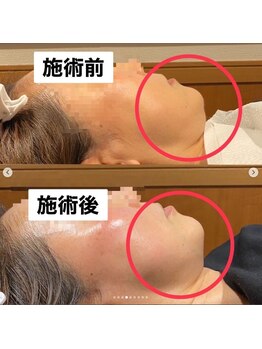 アウンビューティケア AUN薬局(AUN Beauty Care)/小顔ケア♪