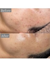 ホワイトアクア 鳳店(WHITE AQUA)/ララピール/大阪/鳳/毛穴/ツヤ肌