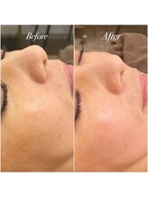 友愛はりきゅう美容整体院/最新毛穴洗浄！esV10 B/A