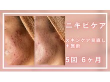 シャルナ(charna)/ニキビ改善