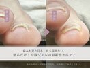 巻き爪ケア