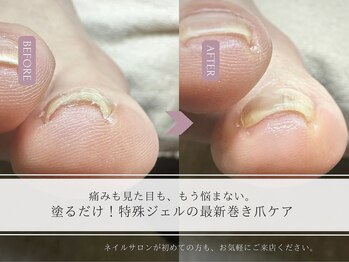 巻き爪ケア