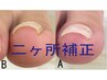 ◇Leyla◇巻爪補正　ニヶ所￥6600