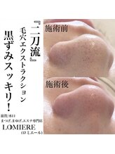 ロミエール(LOMIERE)/毛穴エクストラクション　7900