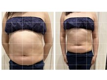 カリオン/腸揉み腹スッキリ　キャンペーン