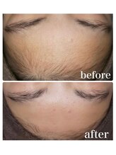 ミーラブ 鹿児島(miilove)/3歳から通えるキッズ脱毛