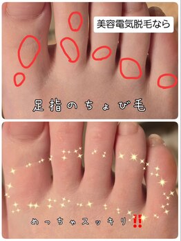 ベビースキン(baby skin)/美容電気脱毛