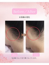 ミラ(Mira)/レディースうなじ脱毛の変化