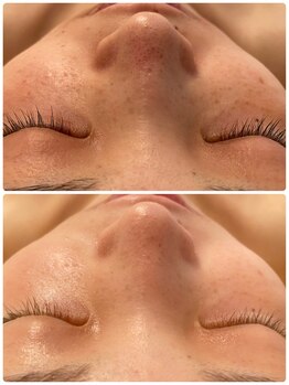 ラポッシュ(La poche)/【肌質改善】毛穴の症例