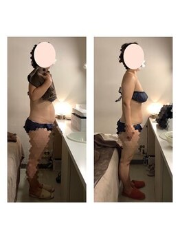 アクア エステティコ 亀有(ACQUA estetico)/痩身　腹部　