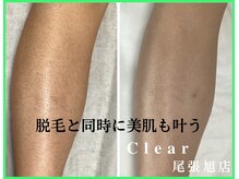 クリア 尾張旭店(Clear)/【Clear脱毛ビフォーアフター】