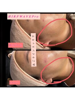 ティアメディカル(Tia Medical)/HIRFWAVEPro