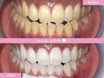 エクシアホワイトニング 札幌中島公園店/ホワイトニングビフォーアフター
