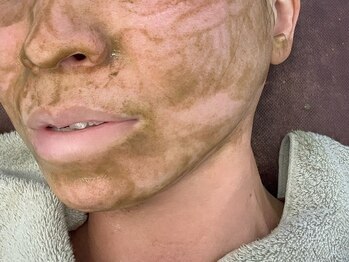 澄葉 新宿(sumiha)の写真/≪大人気≫ツヤ肌へ導くハーブピーリングで毛穴ケア♪全顔・背中・お尻まで対応◎施術後のお化粧ノリもUP!