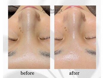 アン ビューティー(ann beauty)/施術1回【症例写真】20代