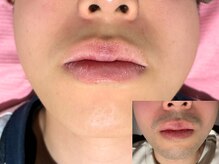 ブレイヴ(BRAVE)/【ヒゲ脱毛】鼻下/あご→15回目