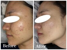 ノア 新宿(Noa)/ハーブピーリング＋マシン 6回