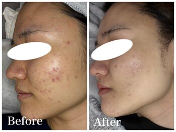 ノア 新宿(Noa)/ハーブピーリング＋マシン 6回