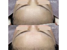 ホワイトワックス 浜松(WHITE WAX)/おでこのくすみもすっきり