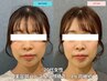 【小顔/左右バランス】美容鍼 ＆小顔矯正　1ヶ月 3回分 ￥19,800！！