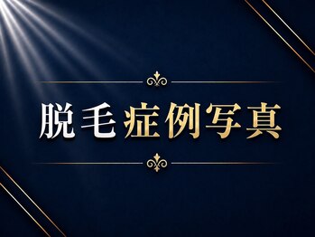 メンズラボ 京都駅前店/脱毛ビフォーアフター