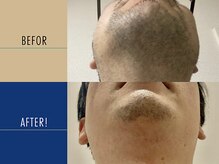 ロペス(Lopez)/【ヒゲ脱毛】14回施術例