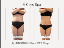 クリオスパ せんげん台駅前店(Cryo Spa)/脂肪冷却