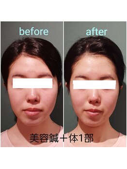 エルアンドエス(L&S)/むくみ解消で小顔＆首も綺麗に！