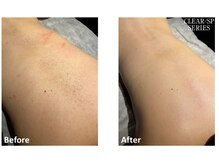 ロカビリー(Rockabilly)/レディース　背中脱毛