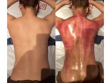 マーズ(Mars)/脂肪セル撃退