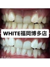 ホワイト 福岡博多店(WHITE)/ホワイトニング通い放題ビフォー