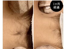 レイカ(Reica)の雰囲気（うなじ脱毛で横顔・後ろ姿も自信が持てる美しさへ♪）