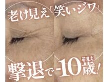 プラズマケアでフェイシャル悩みを改善！内側からエイジングケア