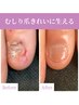 【初回カウンセリング無料】むしり爪のお悩み相談はこちらから♪￥2,200→￥0