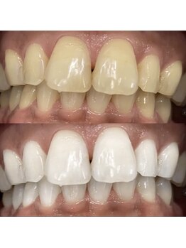 ホワイトニングセンター 京都長岡京店/長岡京・大山崎ホワイトニング