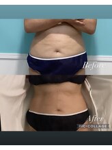 ビーナスアイスブルー(Venus ICE BLUE)/脂肪冷却1回施術1か月経過