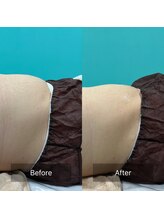 ジューヌ(Jeune)/痩身マシン★ラジオ波