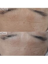 ヴェルシック(Belchic)/シワ改善もお任せください