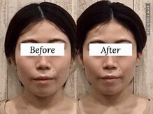 スピード小顔 渋谷店 (Speed)/小顔1回でのビフォーアフター