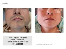 ひげビフォーアフター