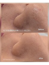 ルフ エステティック ビューティー(ruf esthetic beauty)/毛穴洗浄+顔脱毛