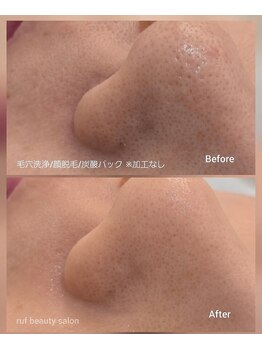 ルフ エステティック ビューティー(ruf esthetic beauty)/毛穴洗浄+顔脱毛