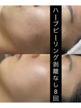 ソアン(Soin)/優しいハーブピーリング