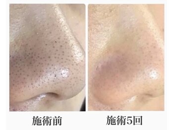 アルゴ 春日那珂川店(ALGO)/毛穴洗浄と幹細胞導入